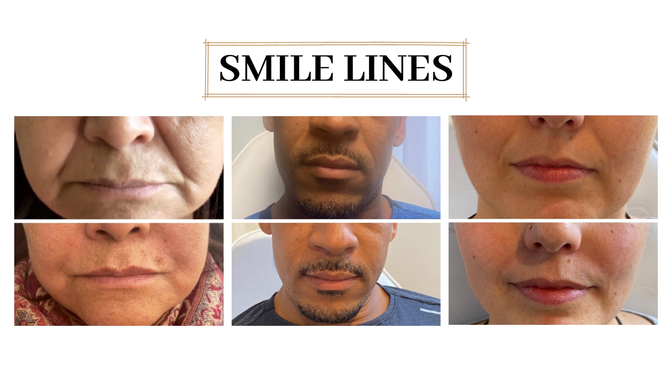 More anti-wrinkle results — original before and after photographs