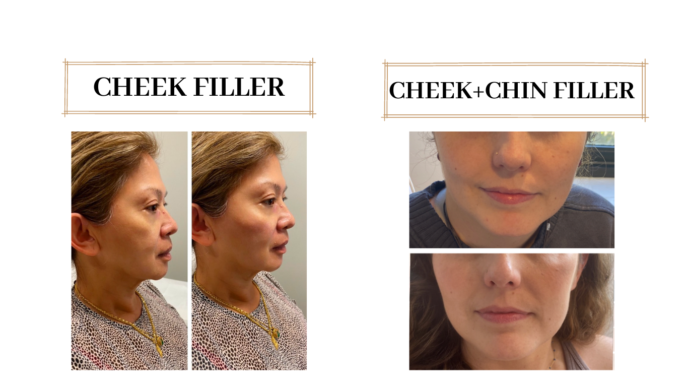 Cheek & chin filler — original before and after photographs