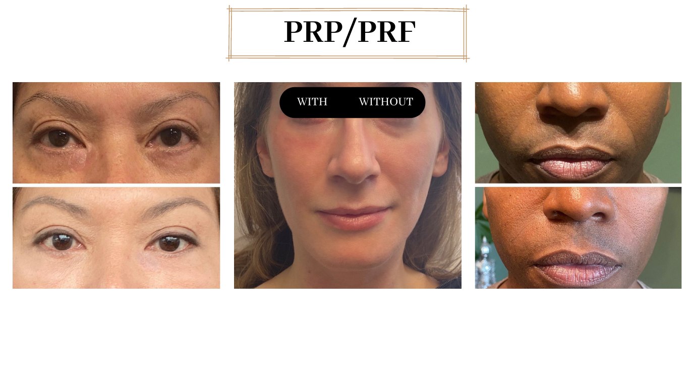 PRP / PRF — original before and after photographs
