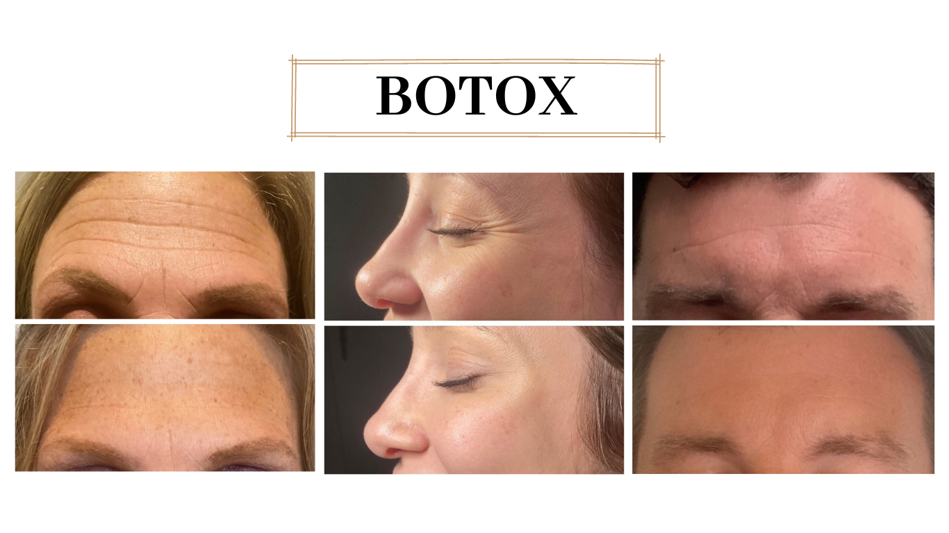 Anti-wrinkle treatments — original before and after photographs