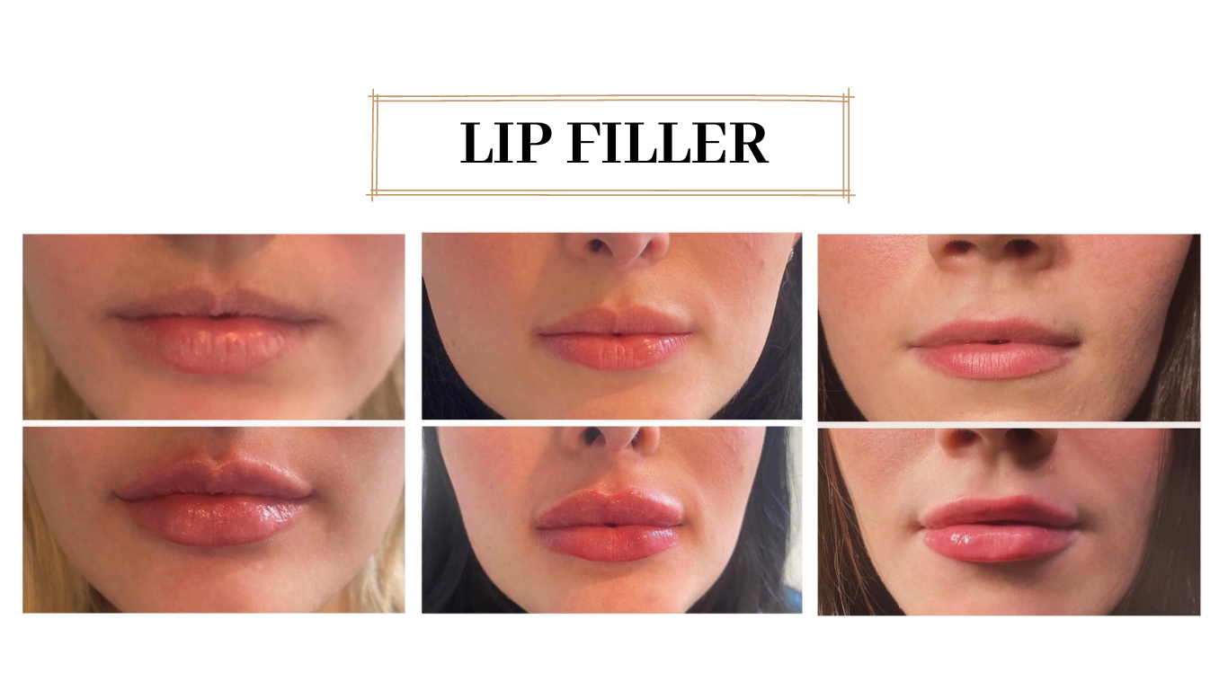 Lip filler — original before and after photographs